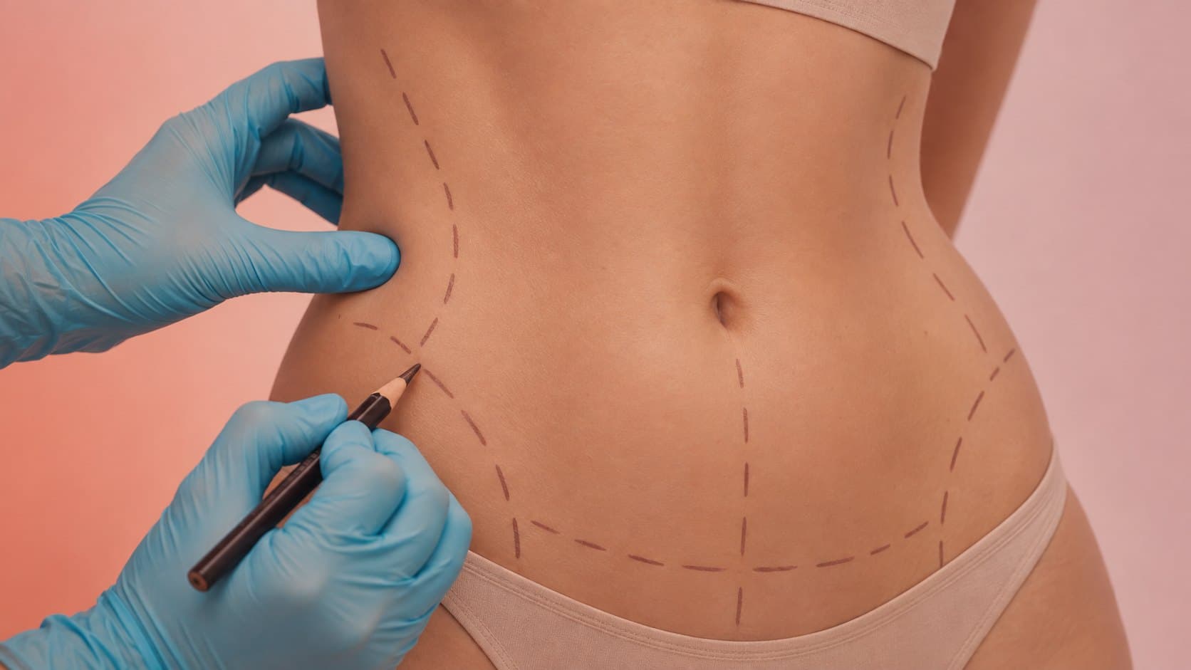 Abdominoplastia